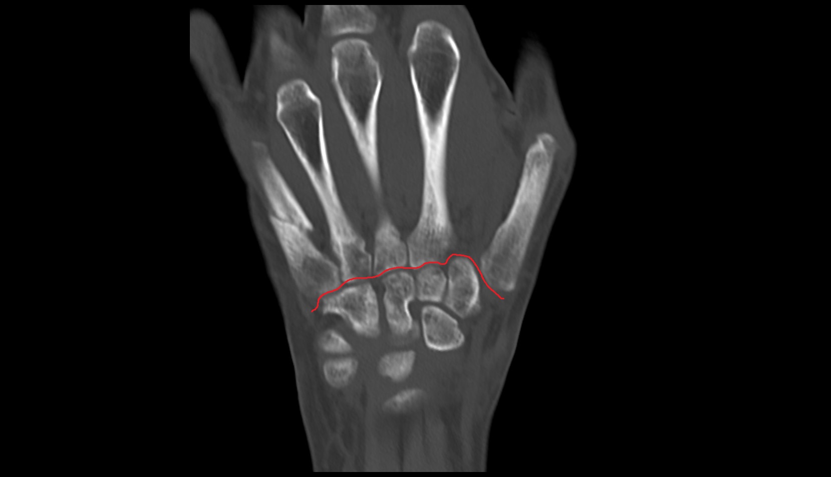 Carpometacarpal joint ct coronal image