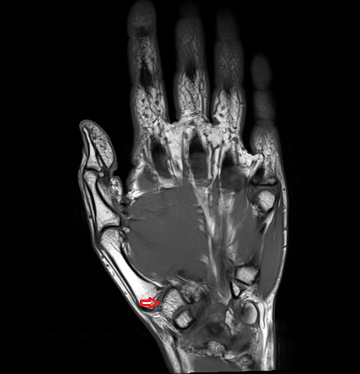 Carpometacarpal joint of thumb mri  anatomy labelled image-img-00000-00000_00001