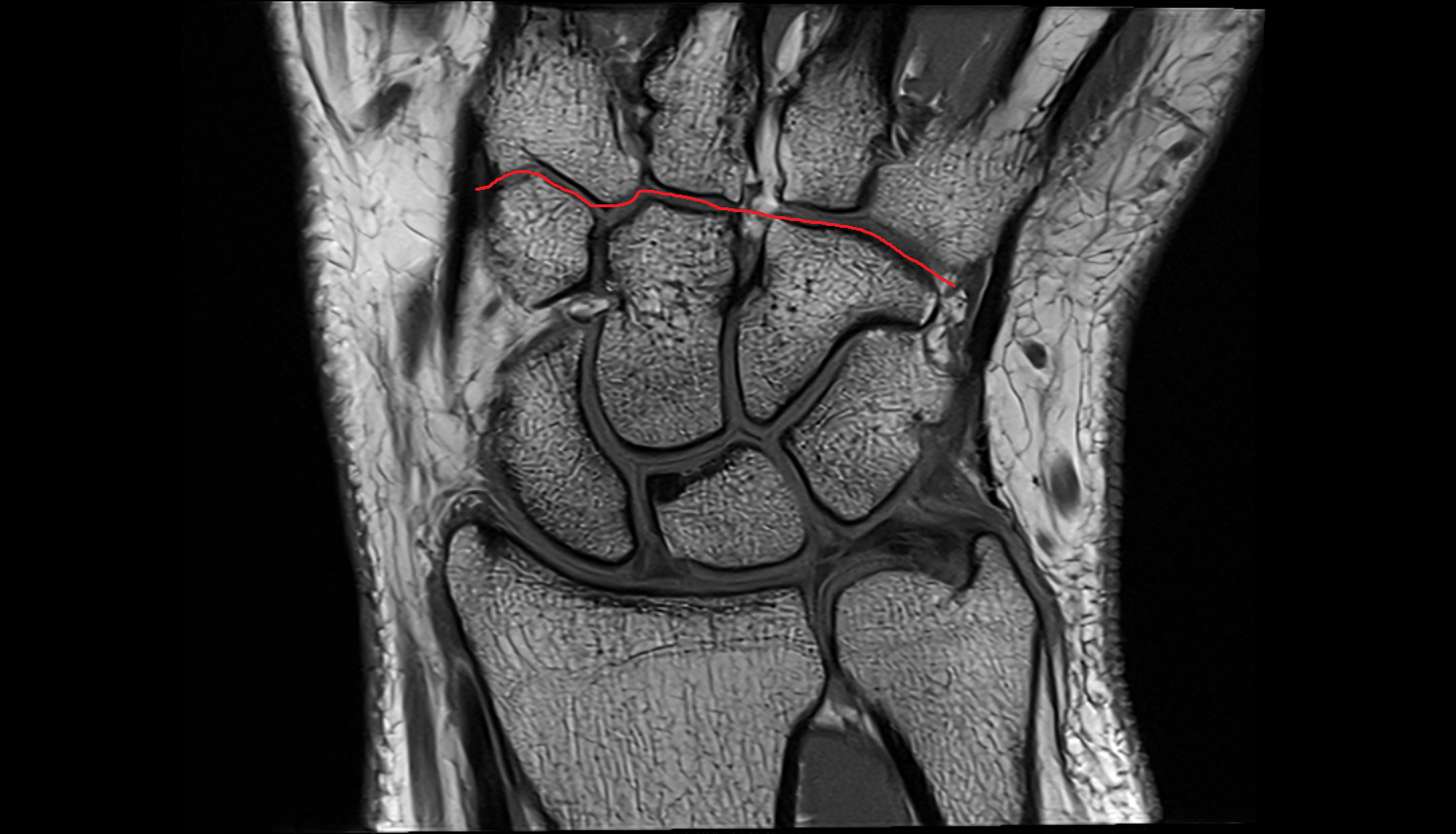 Carpometacarpal joints  coronal cross sectional anatomy 3T MRI AI enhanced radiology image-img-00000-00000