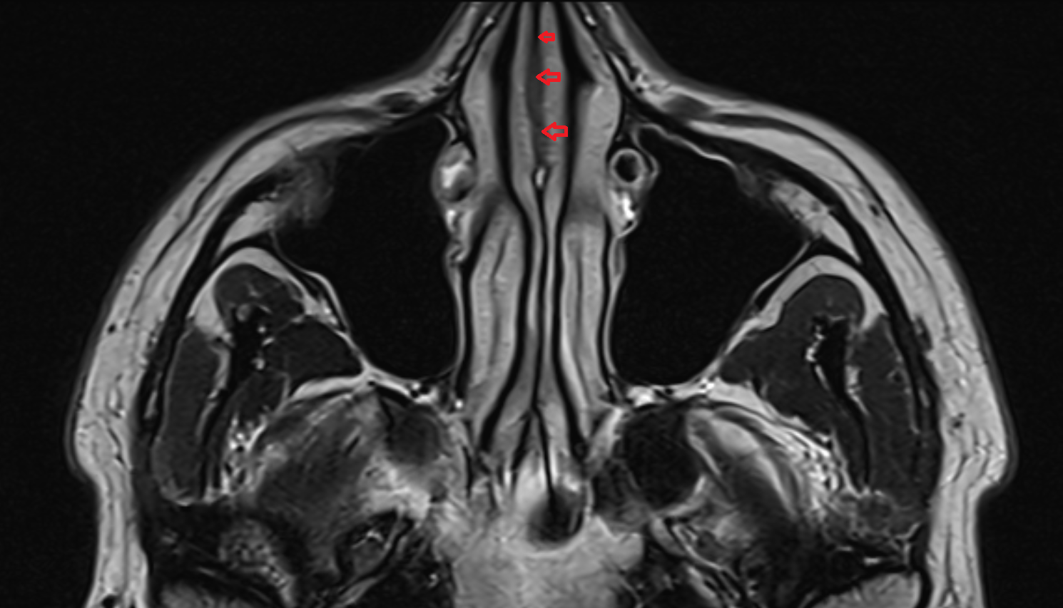 Cartilaginous part of nasal septum MRI  anatomy image -img-00000-00000