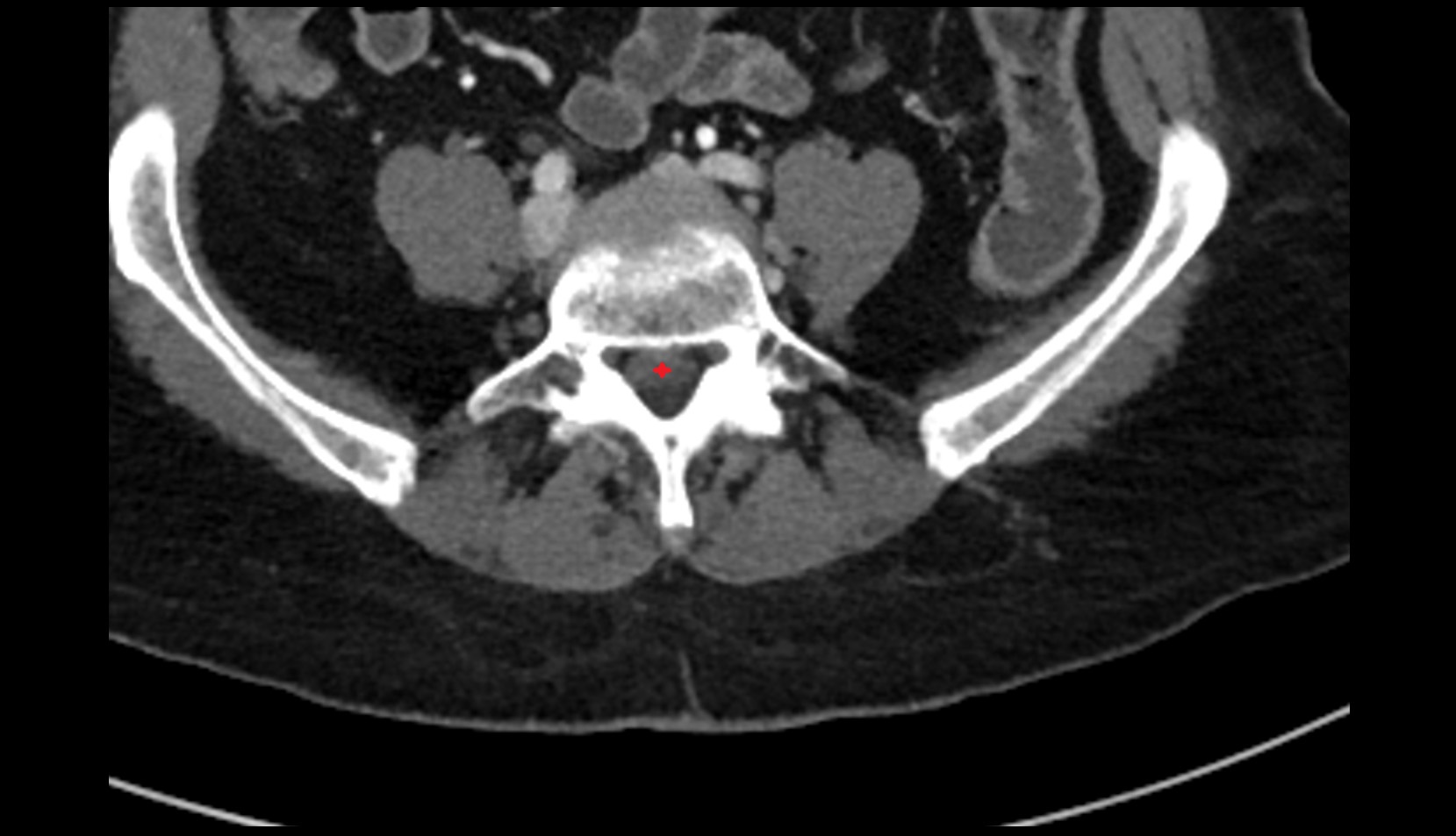 Cauda equina CT axial image