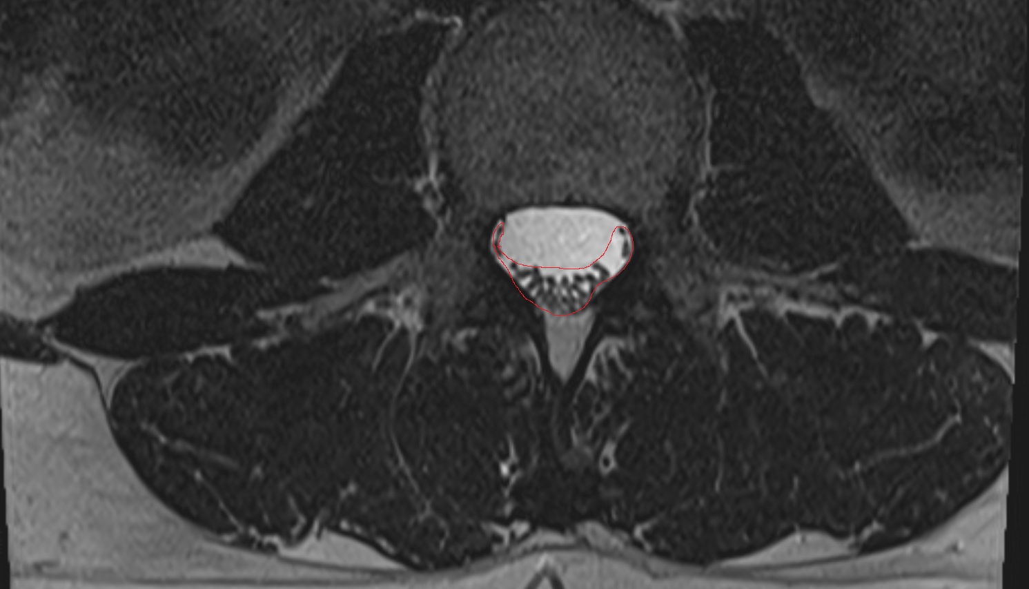 Cauda equina MRI axial  anatomy  image -img-00000-00000