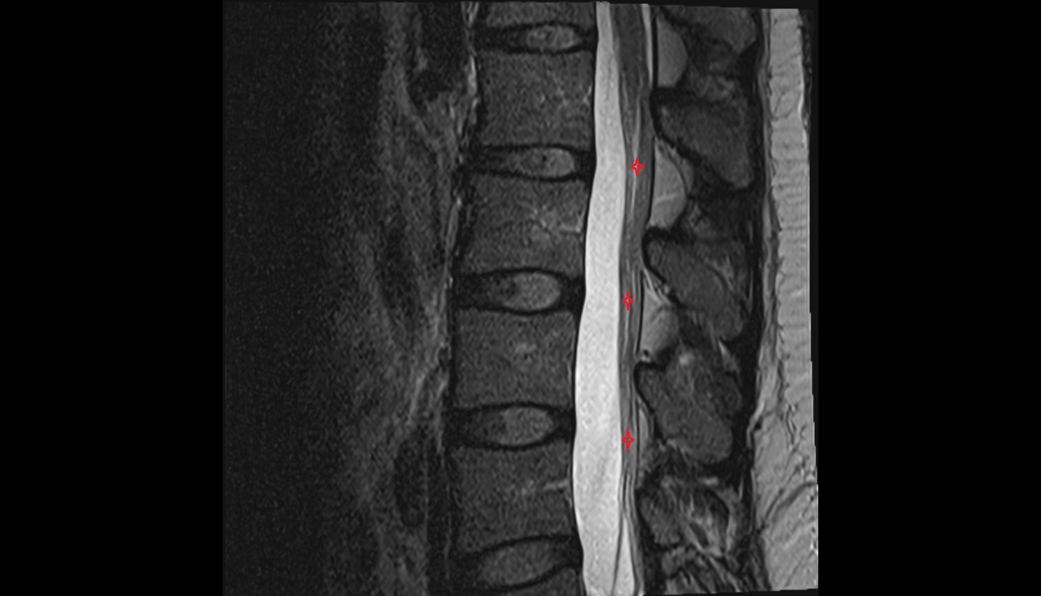 Cauda equina   MRI sagittal  anatomy  image -img-00000-00000