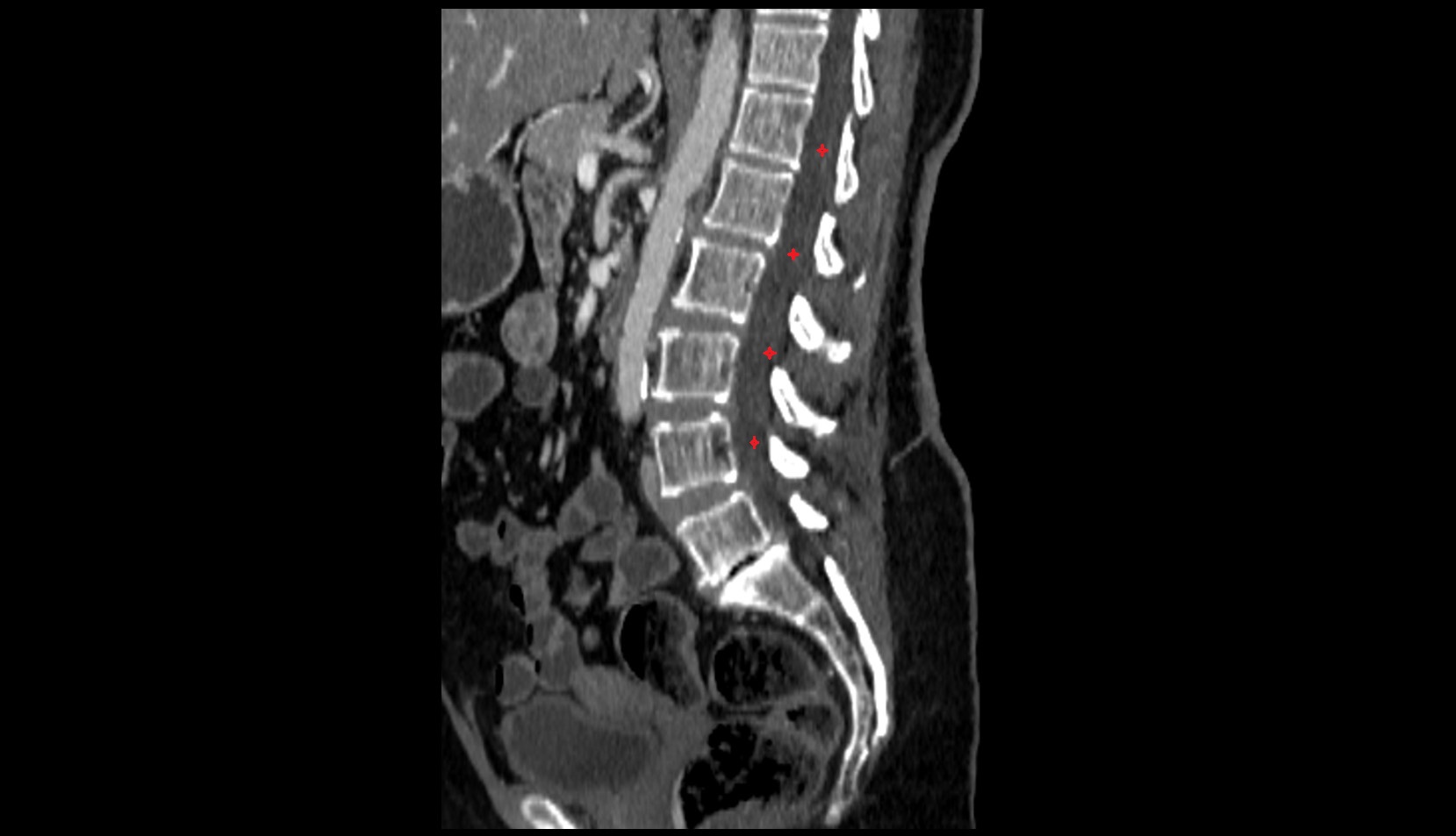 Cauda equina ct sag image