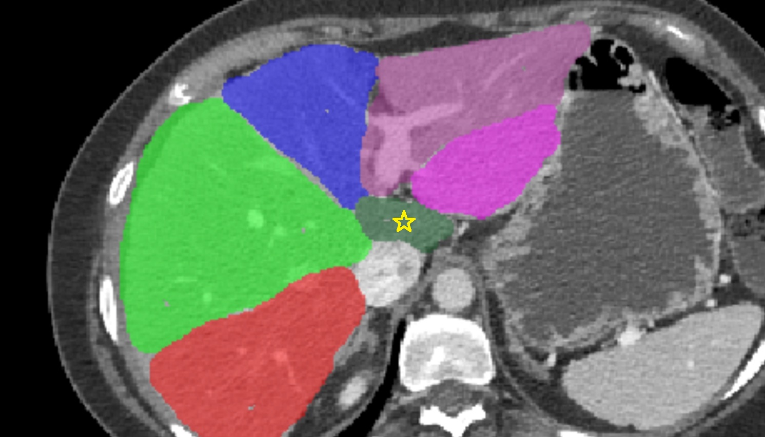 Caudate lobe of the liver  CT  axial  anatomy  image
