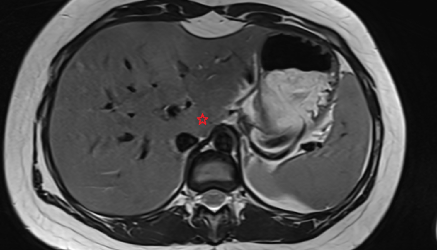 Caudate lobe of the liver  MRI  axial  anatomy  image-img