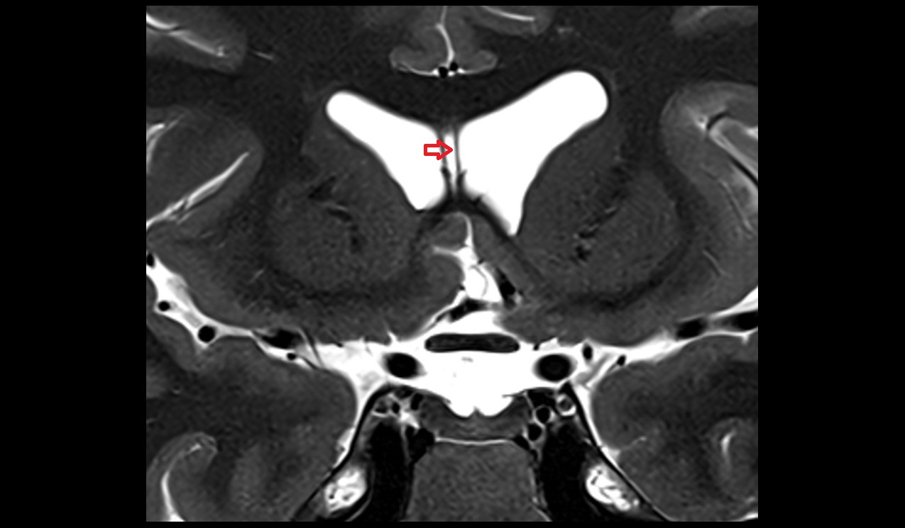 Cave of septum pellucidum mri 3t coronal image