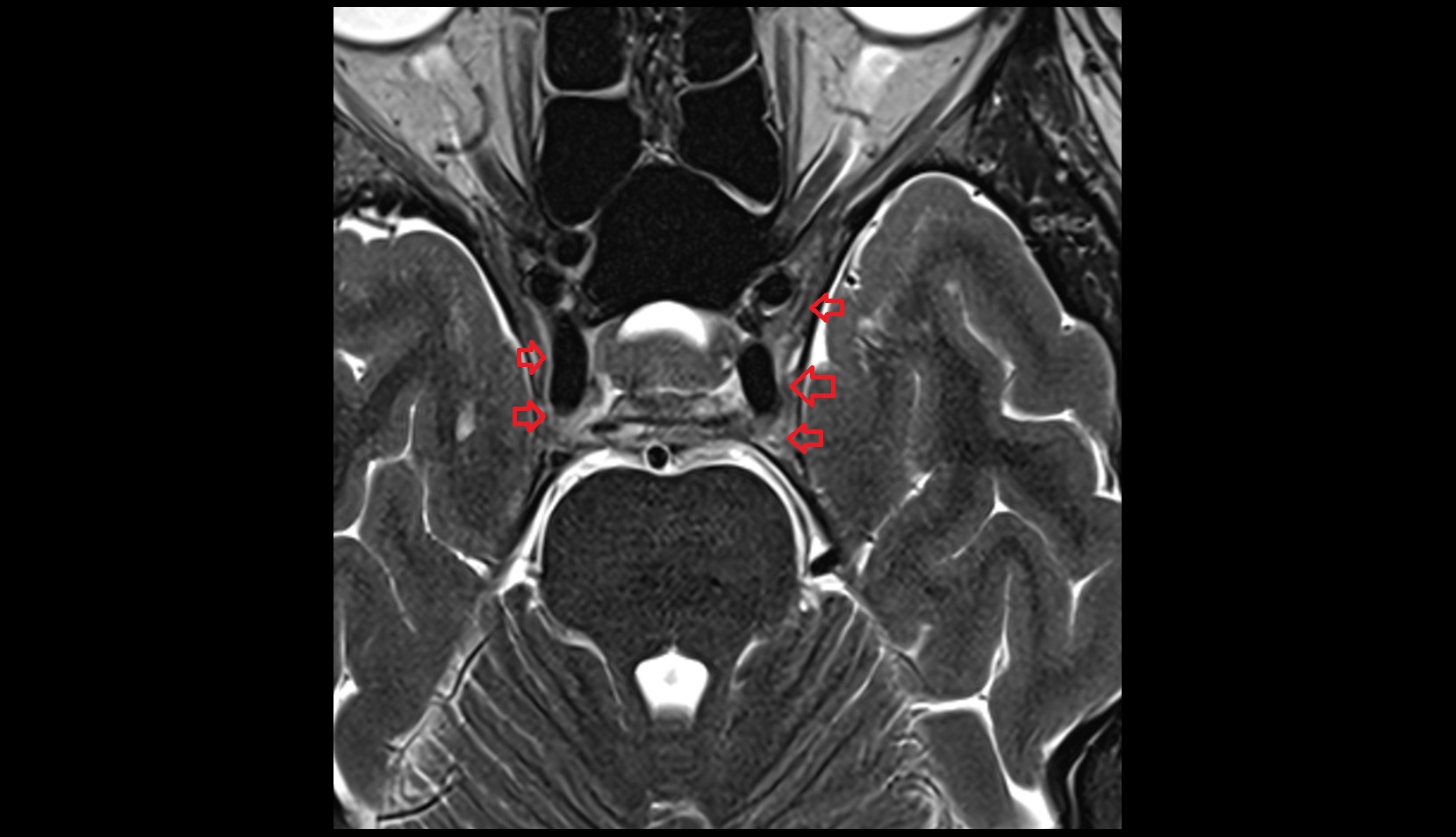 Cavernous sinus MRI axial 3t image