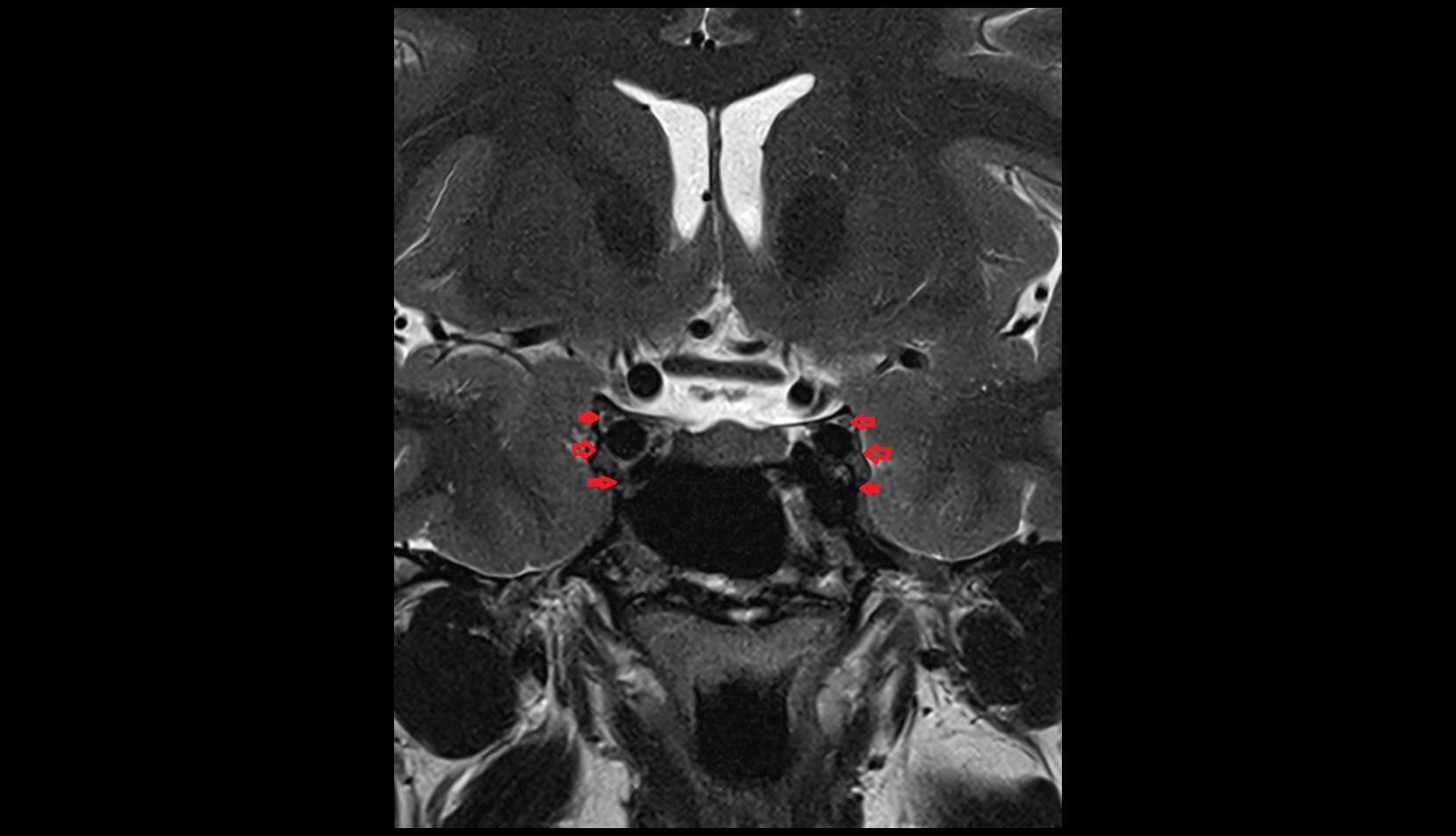 Cavernous sinus MRI coronal 3t image