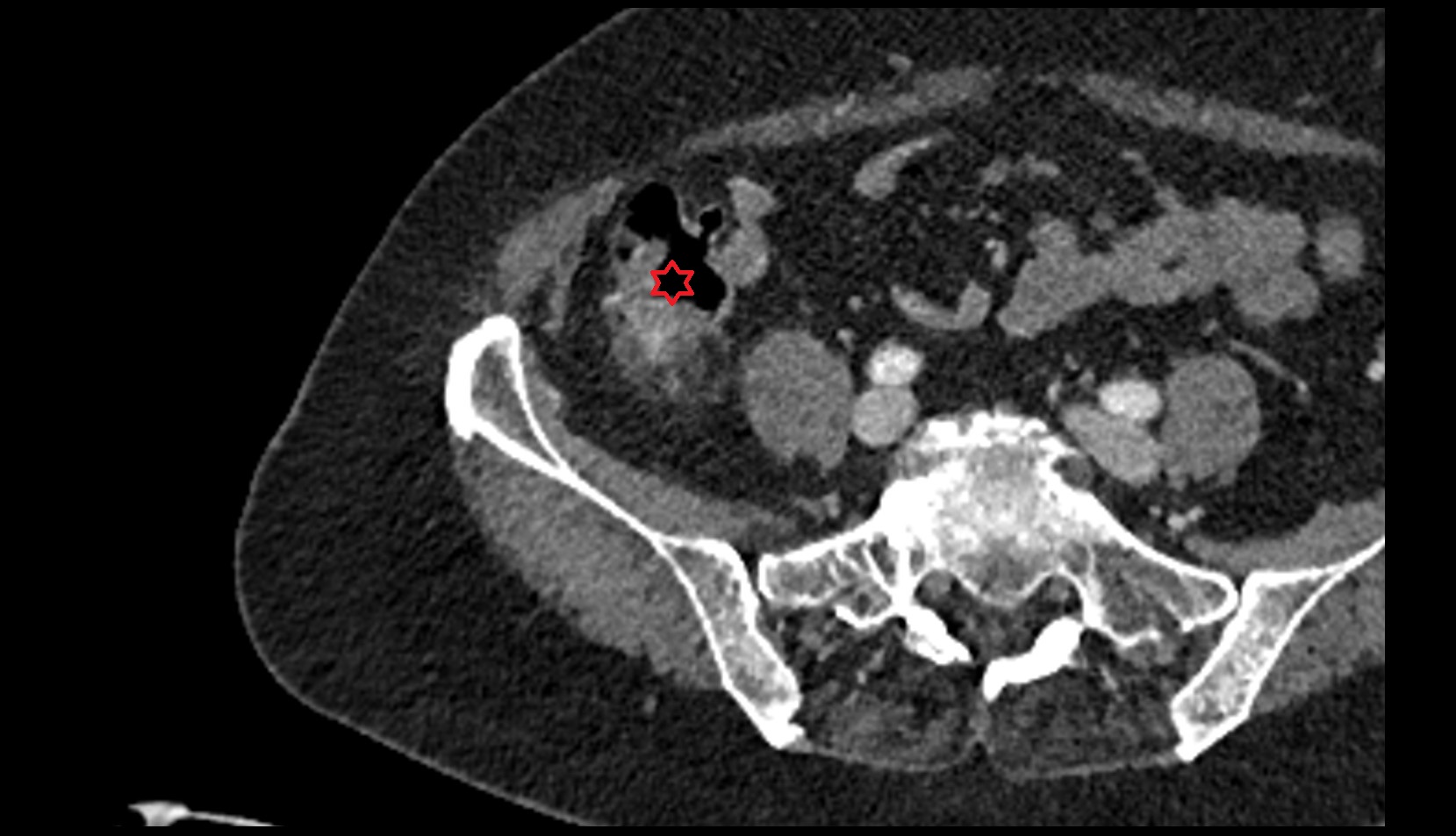 Cecum MRI axial image