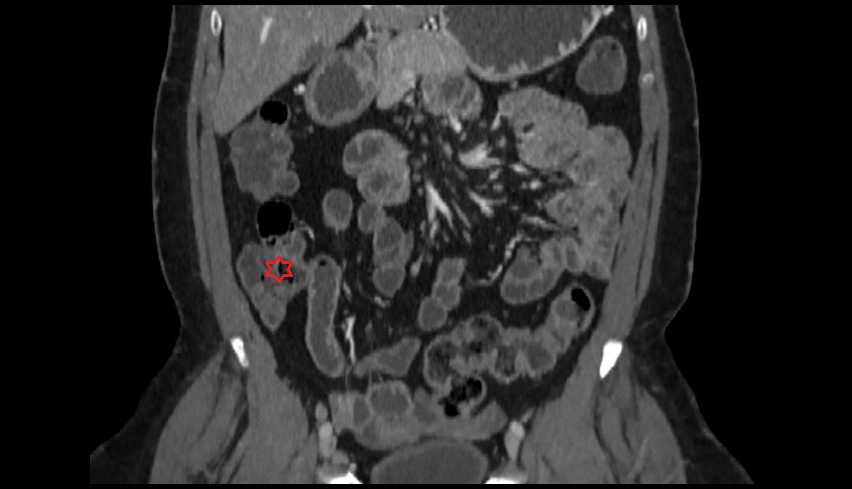 Cecum MRI coronal image