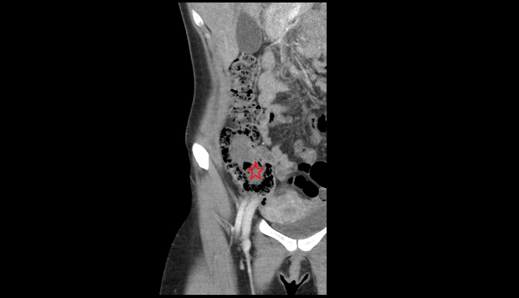 Cecum MRI coronal image 1