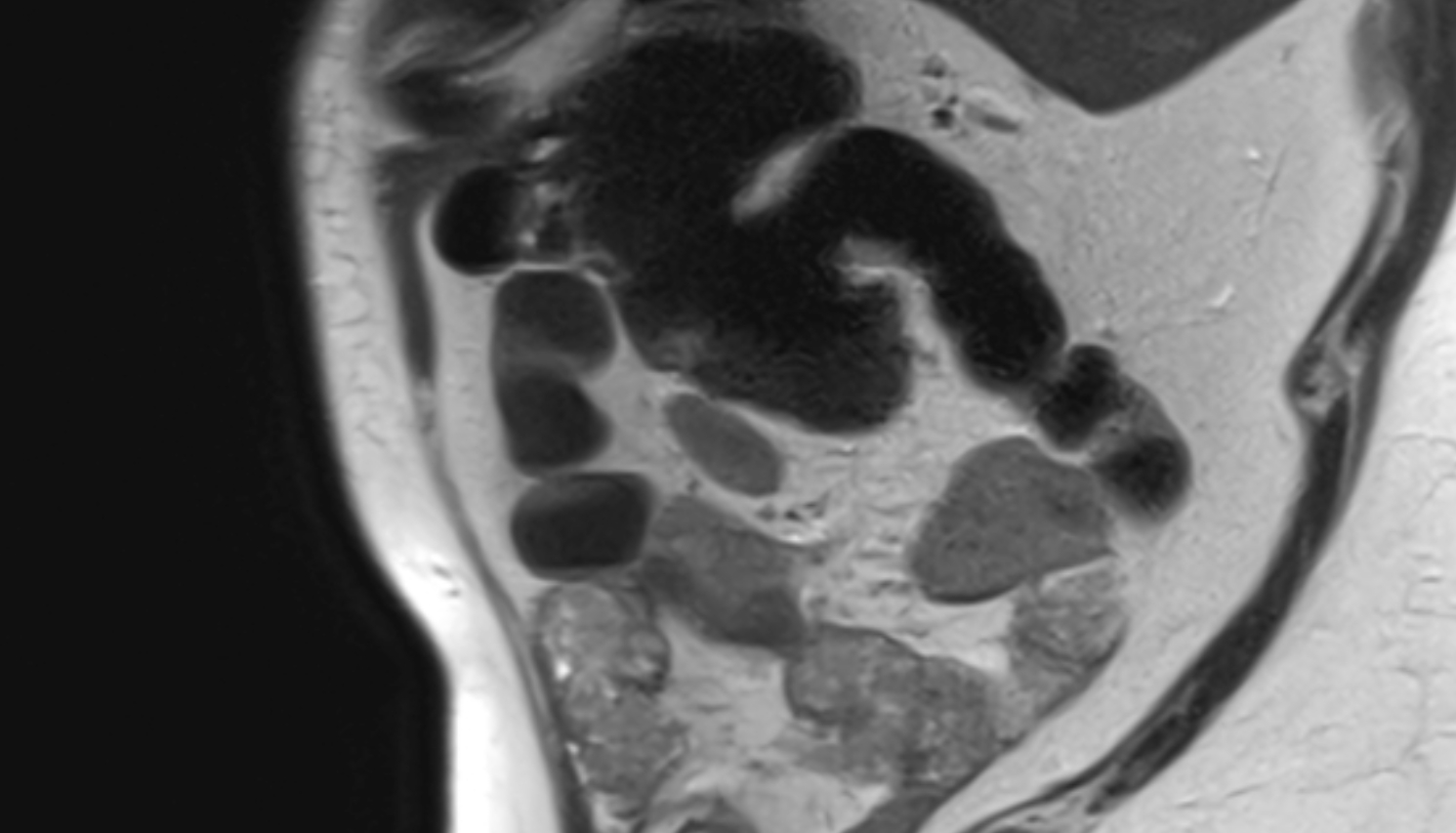 Cecum anatomy   MRI sag  anatomy  image -img-00000-00000