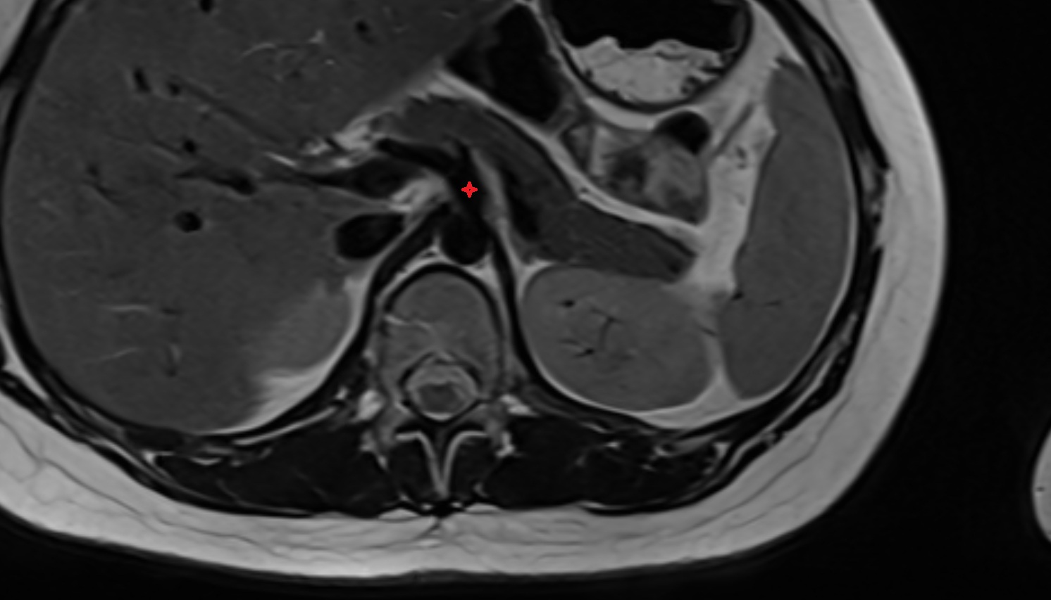 Celiac trunk anantomy  MRI AXIAL  image -img-00000-00000