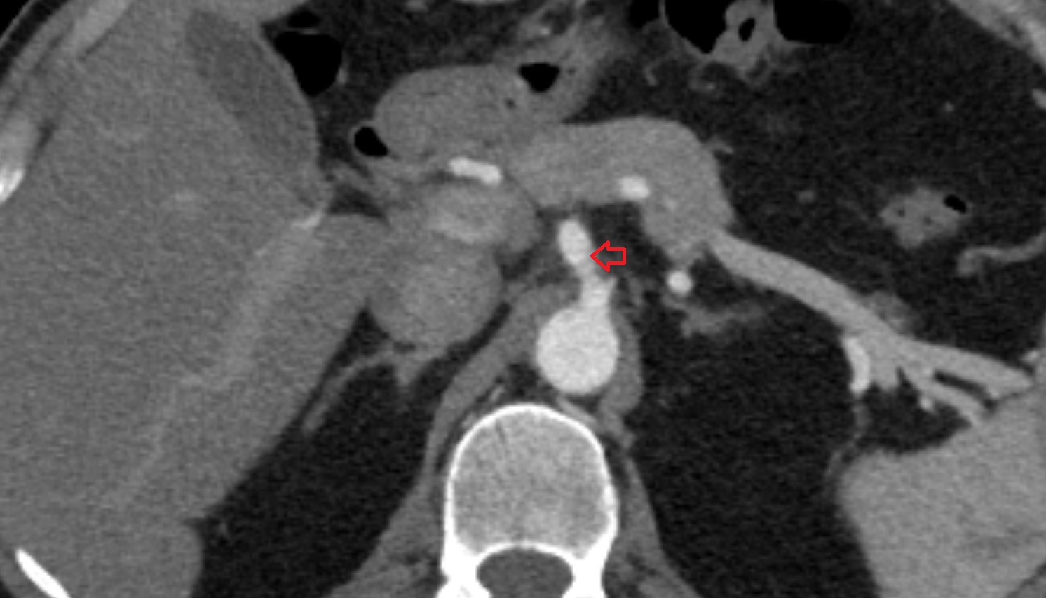 Celiac trunk anantomy  ct  AXIAL  image -img-00000-00000