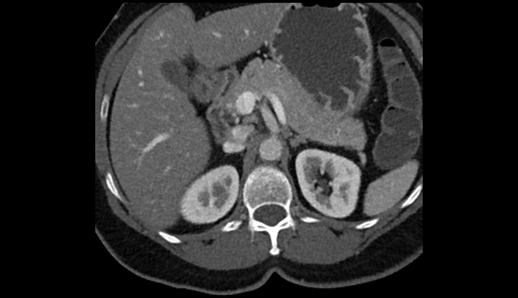 Celiac trunk ct axial