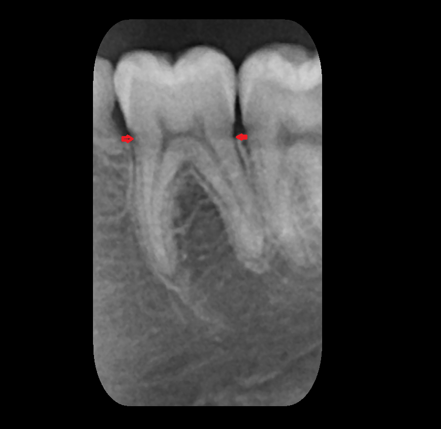 Cementoenamel junction