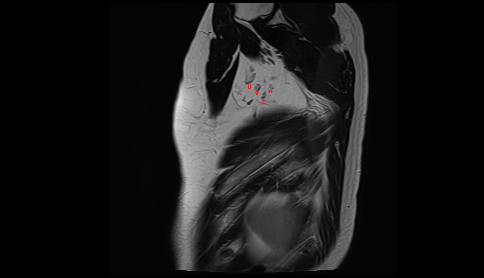 Central axillary lymph nodes MRI sagittal image