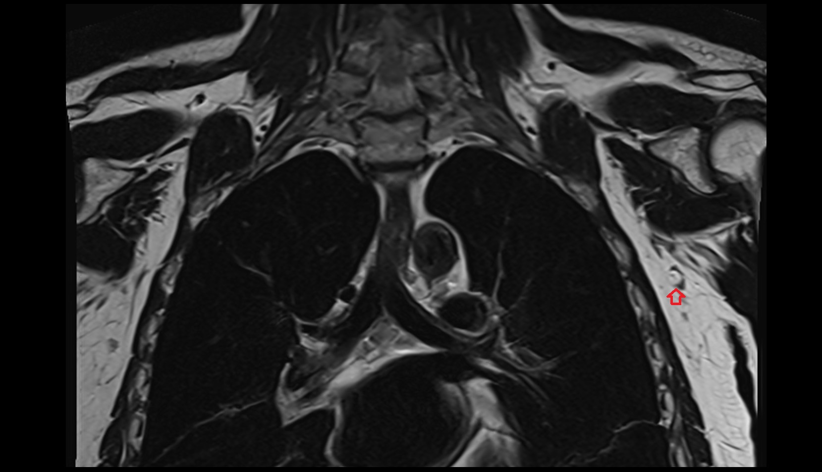 Central axillary lymph nodes coronal