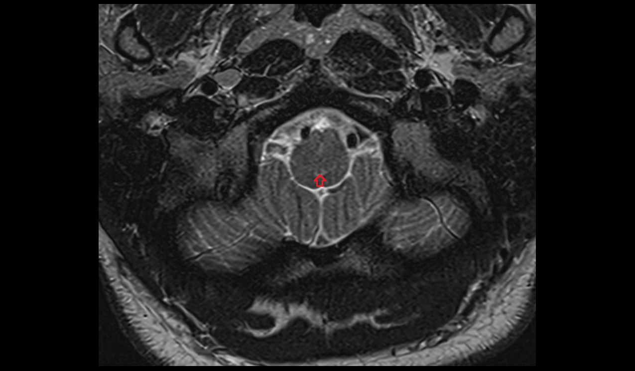 Central canal mri 3t axial image