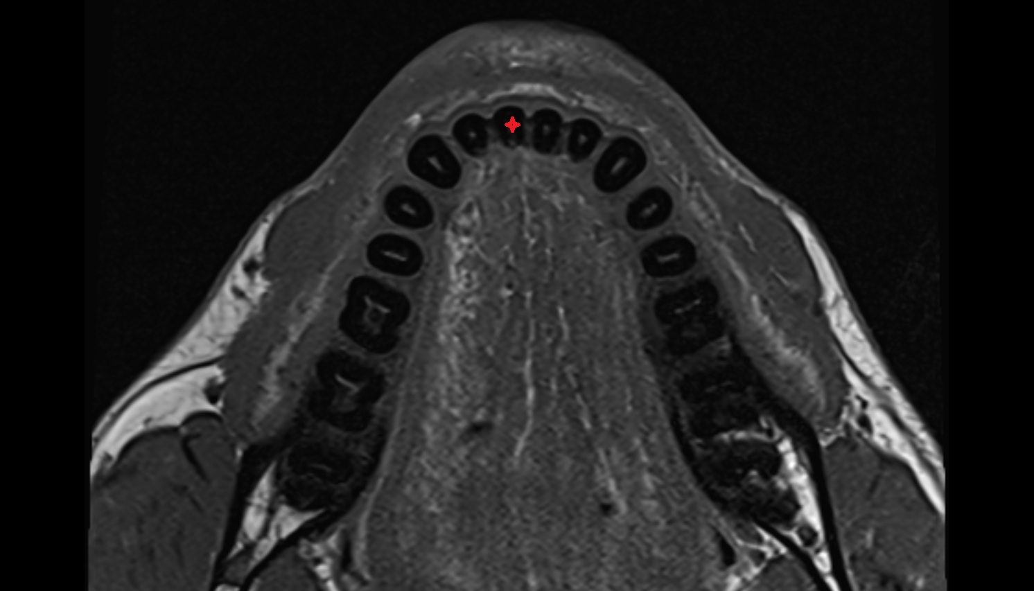 Central inferior incisor tooth mri axial image -img-00000-00000