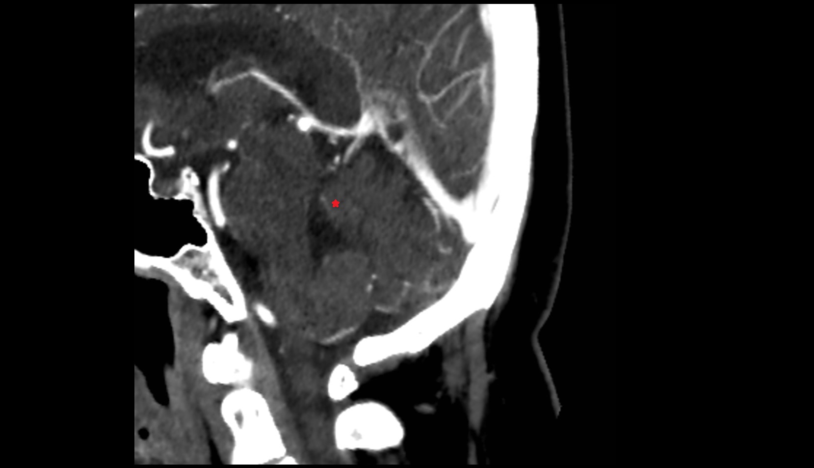 Central lobule CT image
