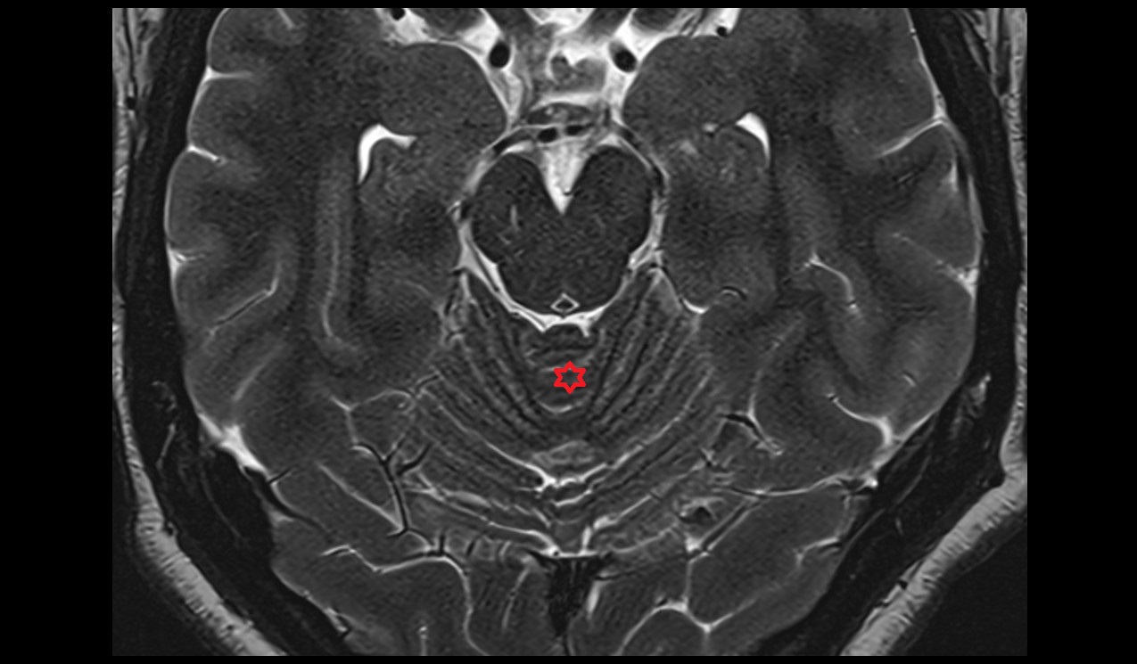 Central lobule MRI 3T axial image