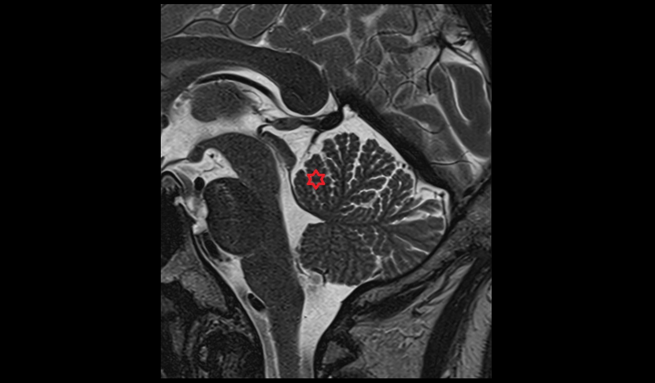 Central lobule MRI 3T sagittal image