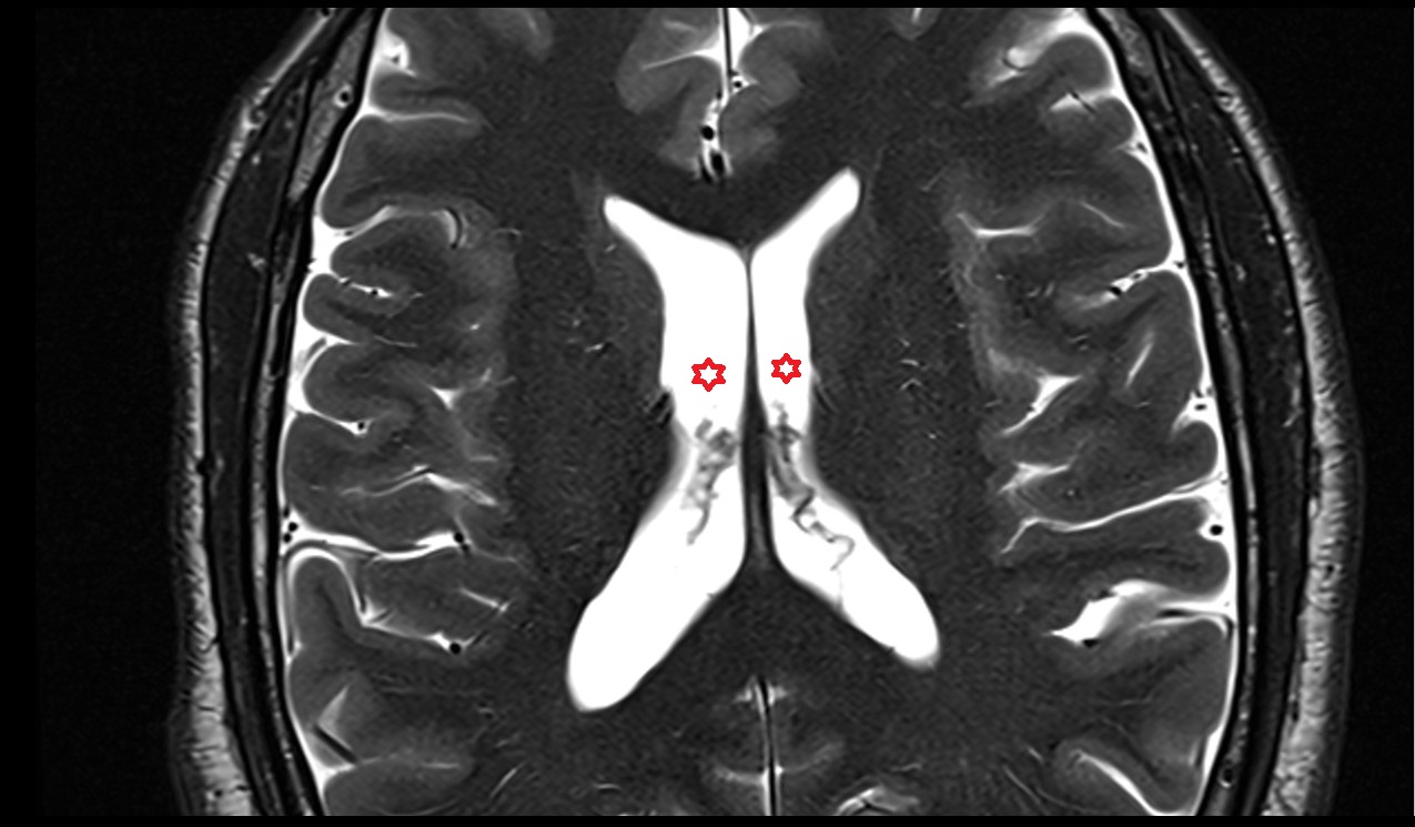 Central part of lateral ventricle; Body of lateral ventricle mri 3t axial image