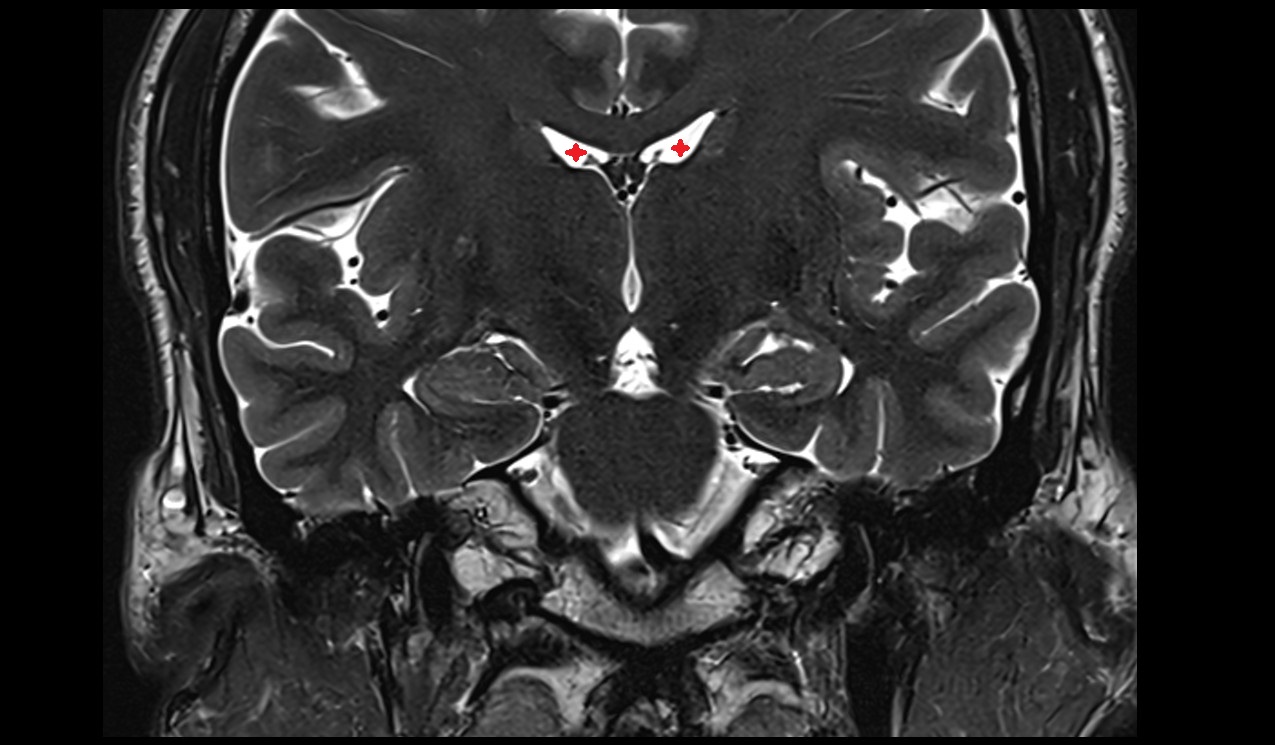 Central part of lateral ventricle; Body of lateral ventricle mri 3t coronal image
