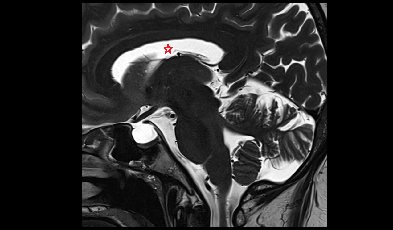 Central part of lateral ventricle; Body of lateral ventricle mri 3t sagittal image