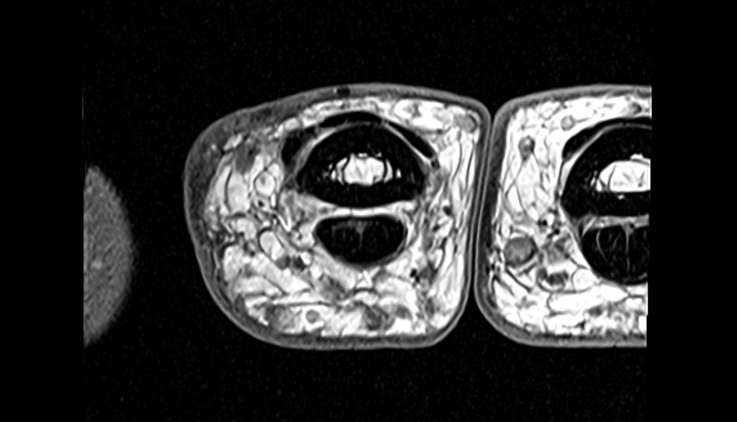 Central slip of common extensor tendon  hand  MRI axial  image-img-00000-00000