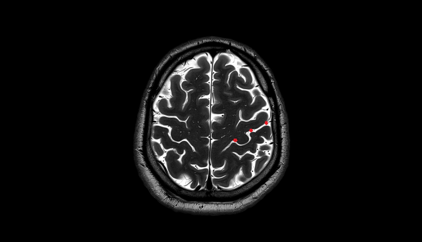 Central sulcus MRI 3T axial image