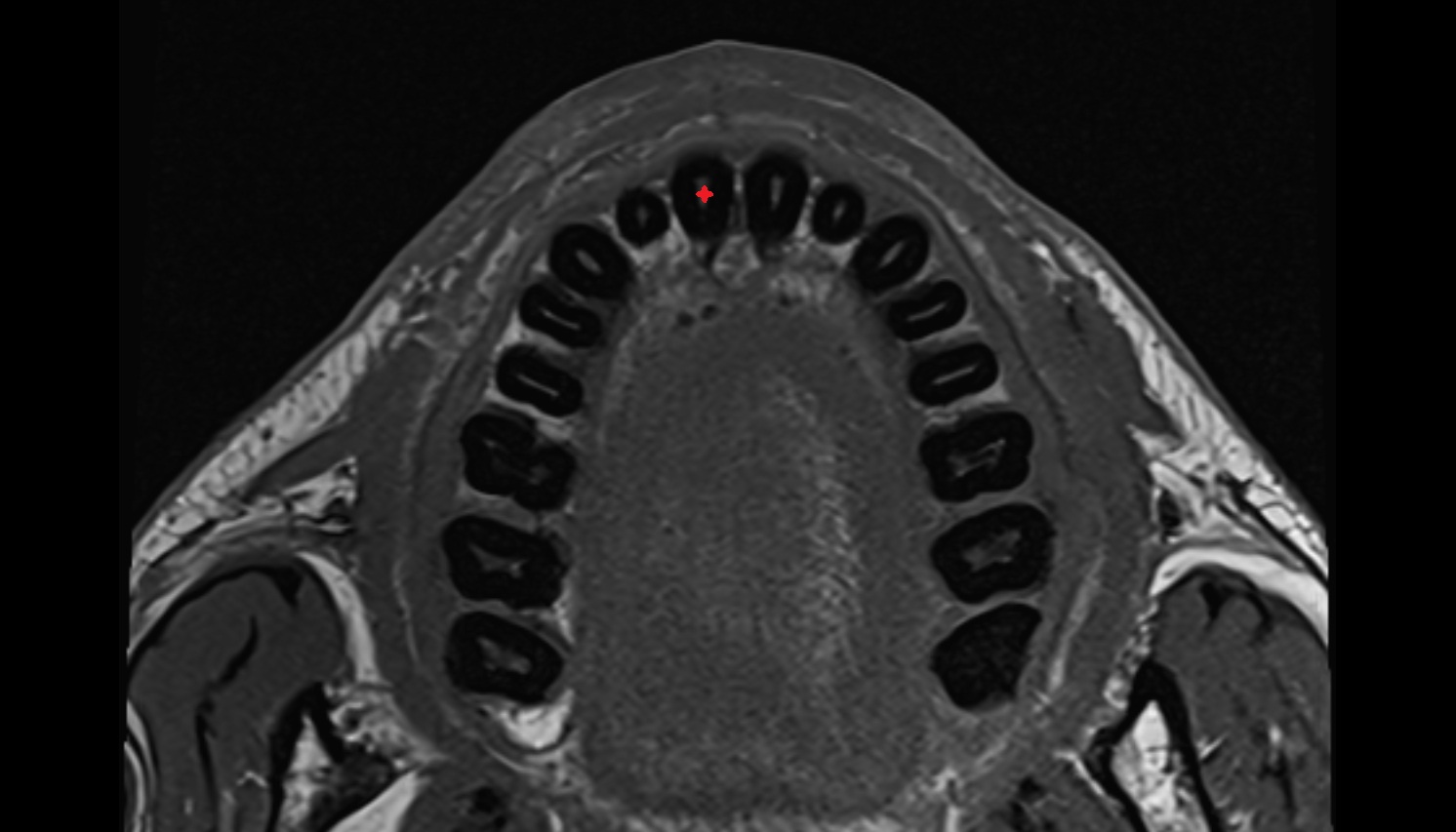 Central superior incisor tooth mri axial image -img-00000-00000