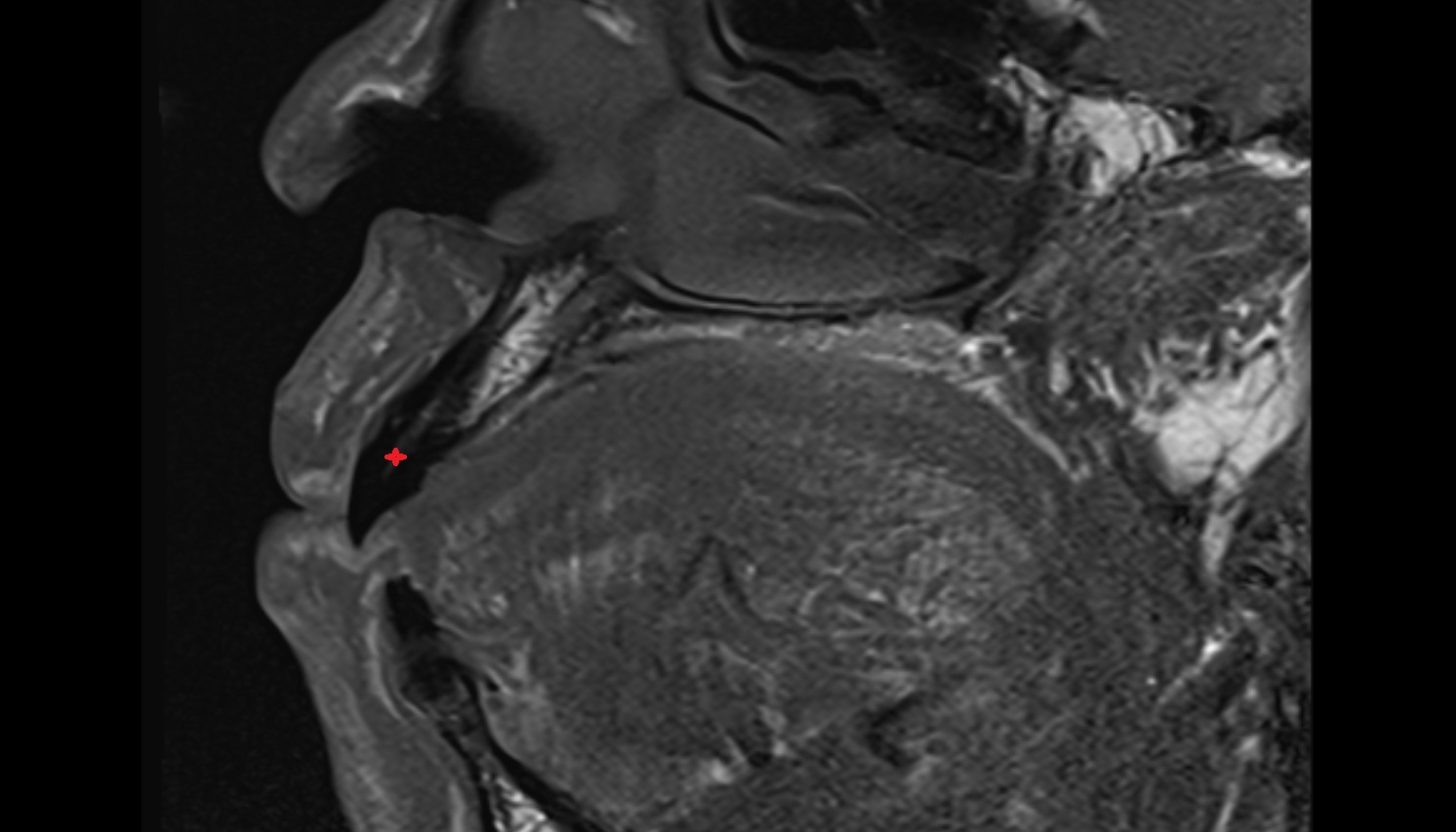 Central superior incisor tooth mri sag image -img-00000-00000