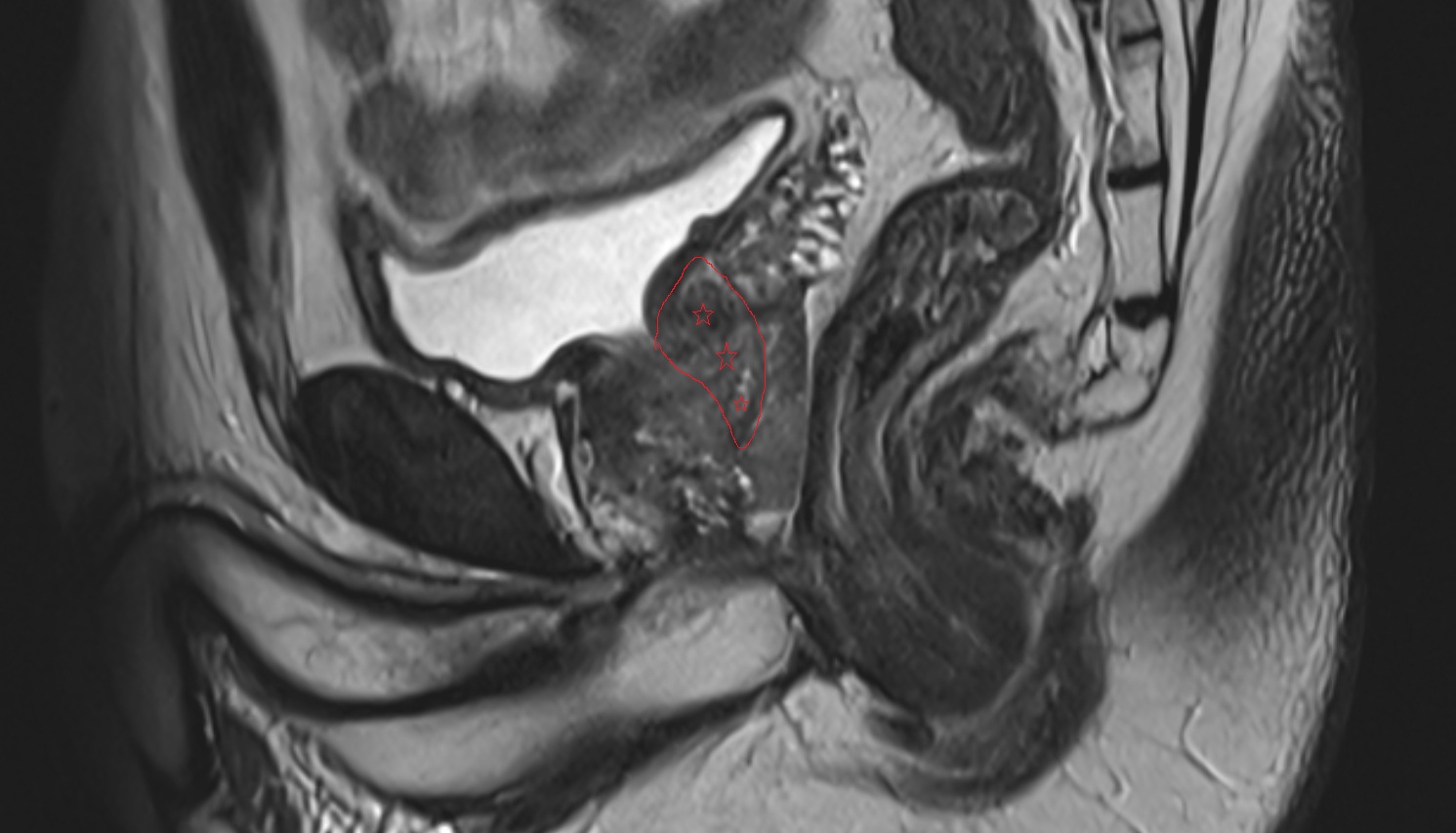 Central zone of prostate  MRI sagittal  anatomy  image-img-00000-00000