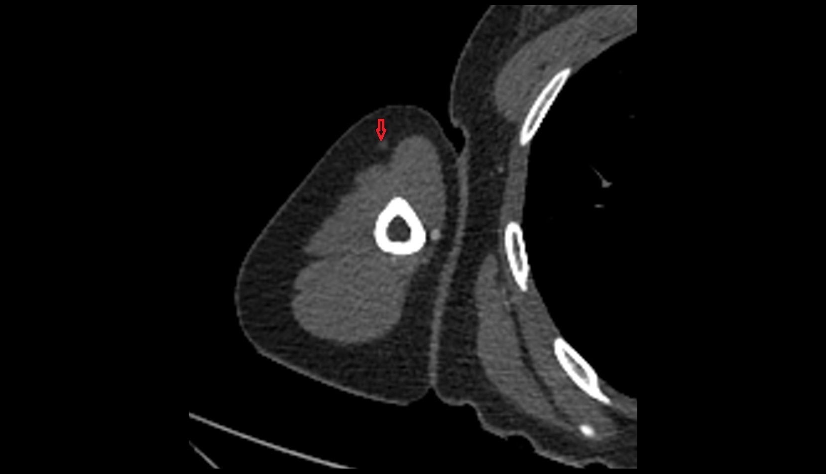 Cephalic vein ct axial