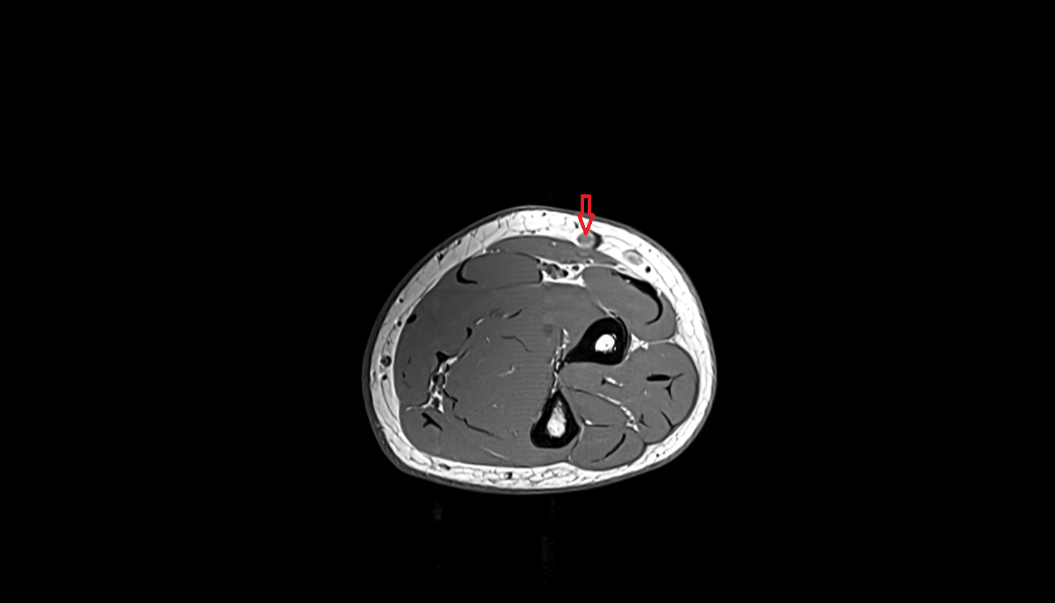 Cephalic vein of forearm axial cross sectional anatomy 3T MRI AI enhanced radiology image -img-00000-00000_00001