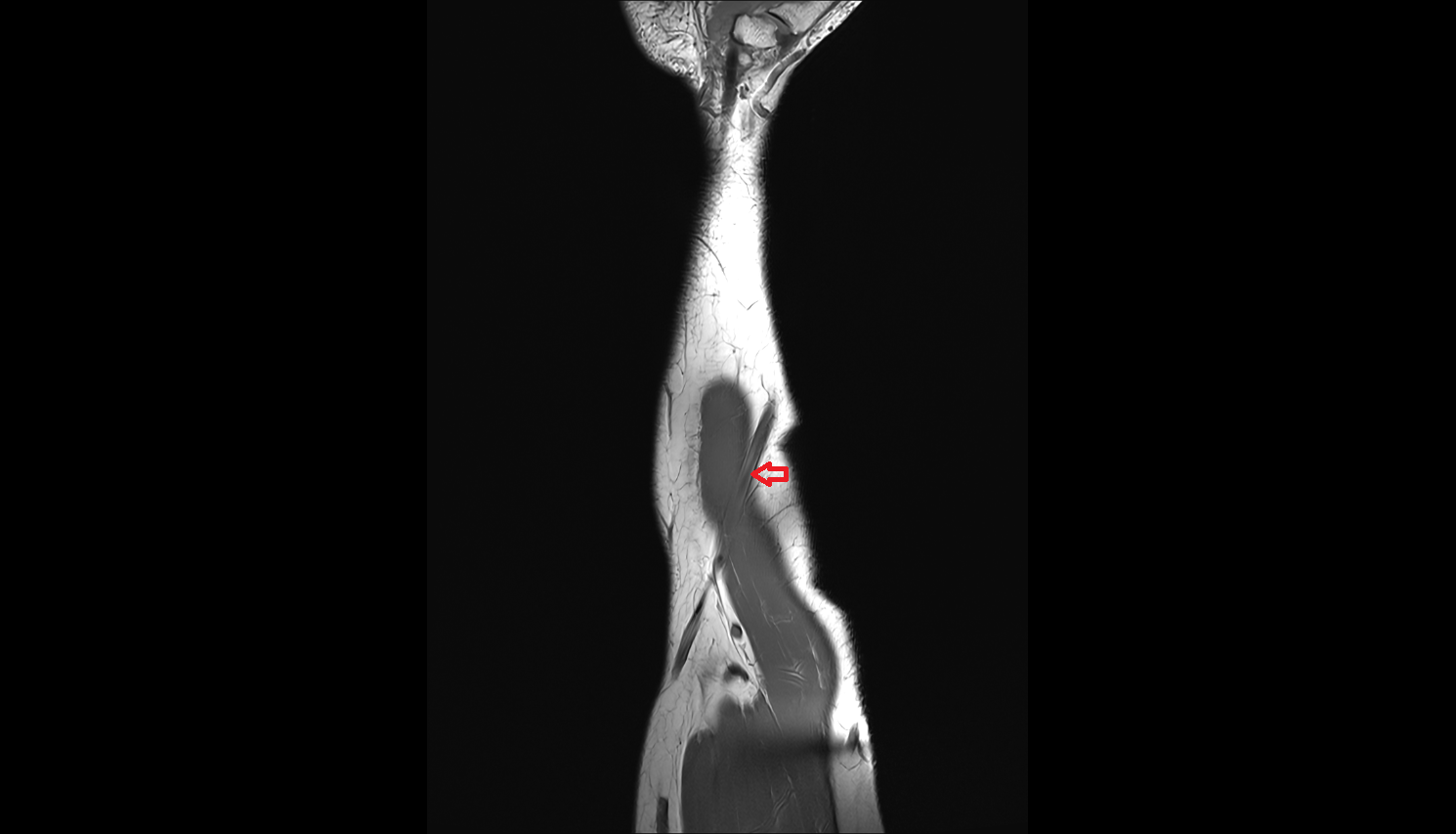 Cephalic vein of forearm axial cross sectional anatomy 3T MRI AI enhanced radiology image -img-00000-00000_00002