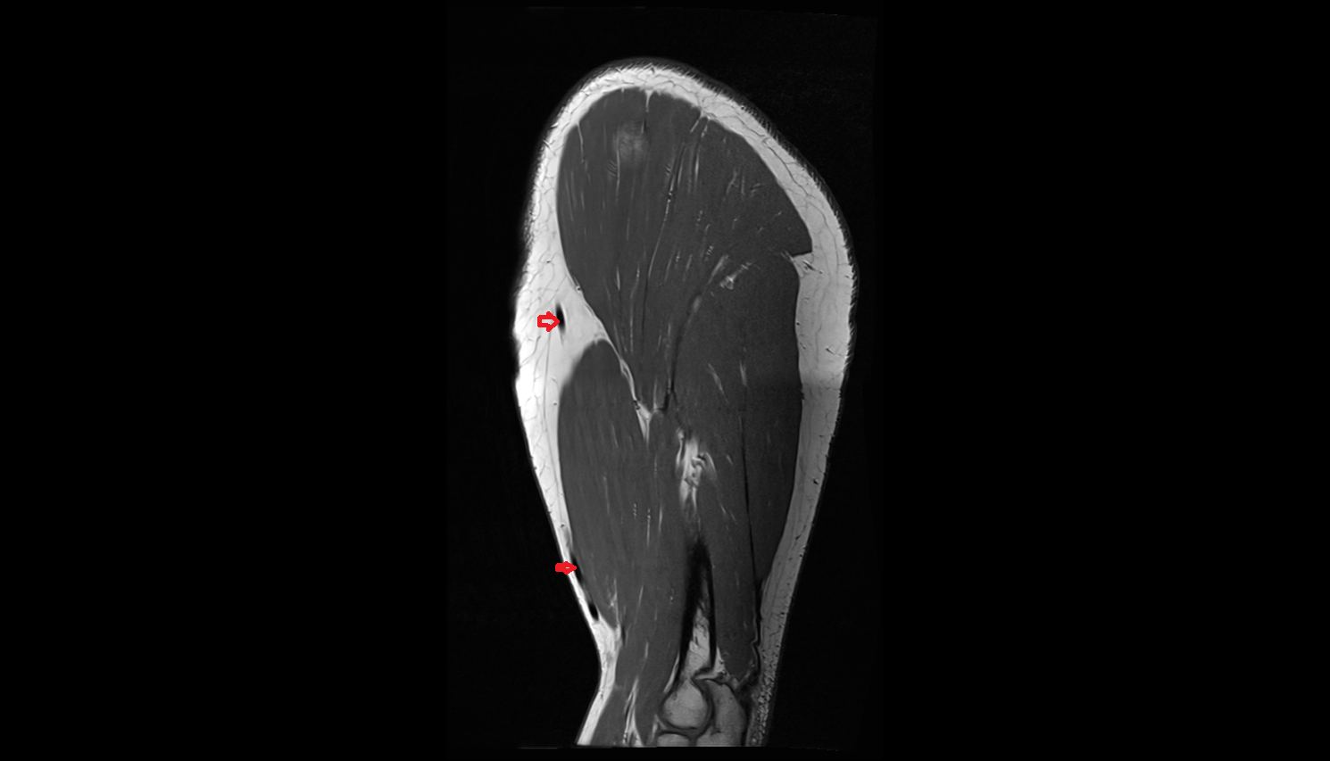 Cephalic vein sag cross sectional anatomy 3T MRI AI enhanced radiology image-img-00000-00000