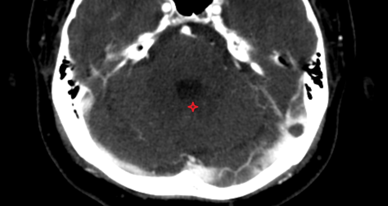 Cerebellar commissure CT axial  anatomy image -img-00001-00001