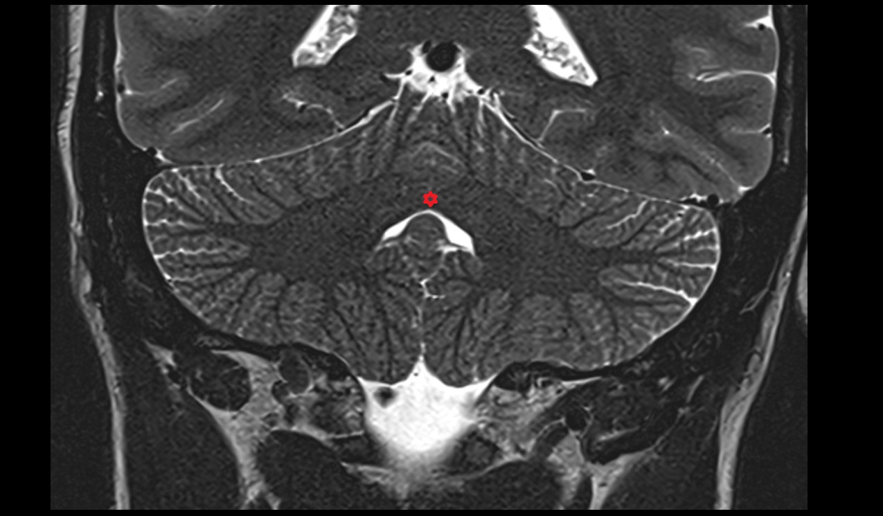 Cerebellar commissure MRI 3T coronal image