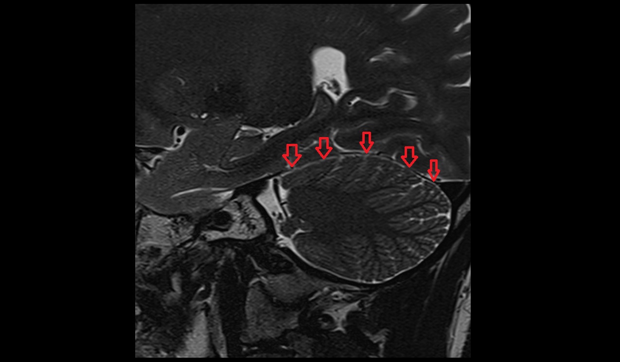 Cerebellar tentorium MRI 3T sagittal image