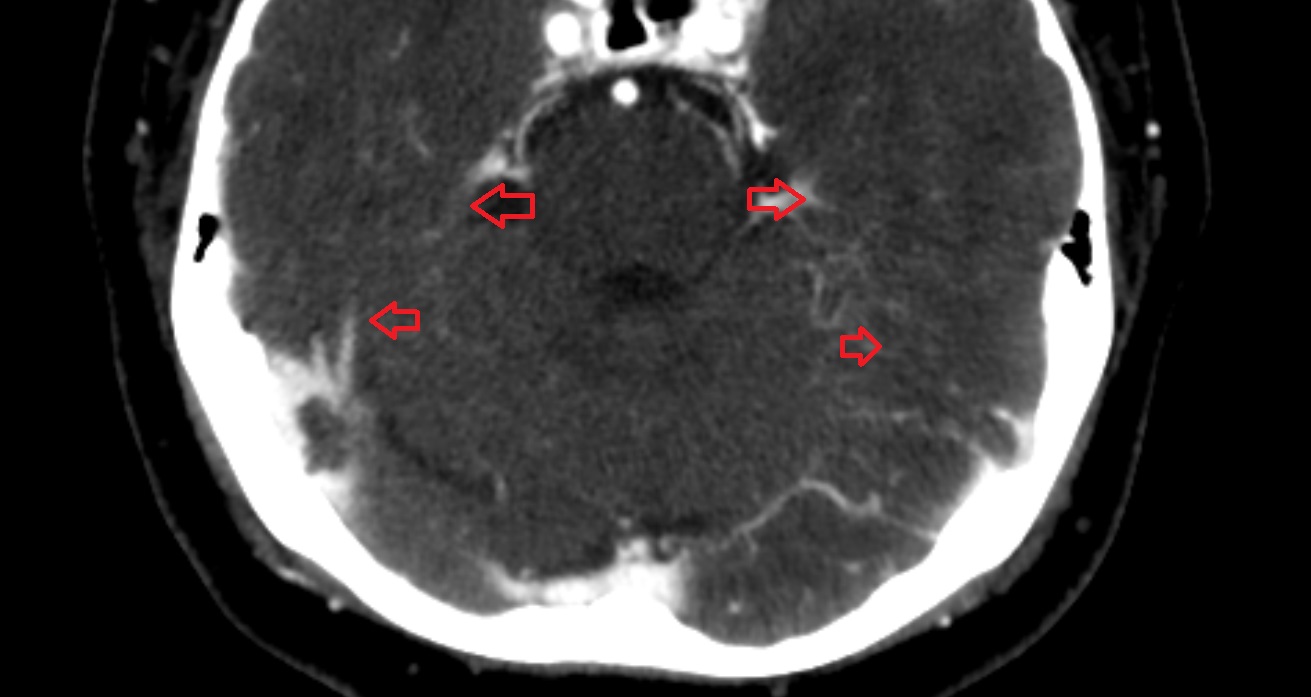 Cerebellar tentorium ct