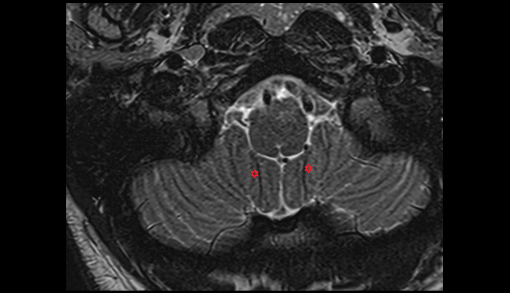 Cerebellar tonsil (H IX)