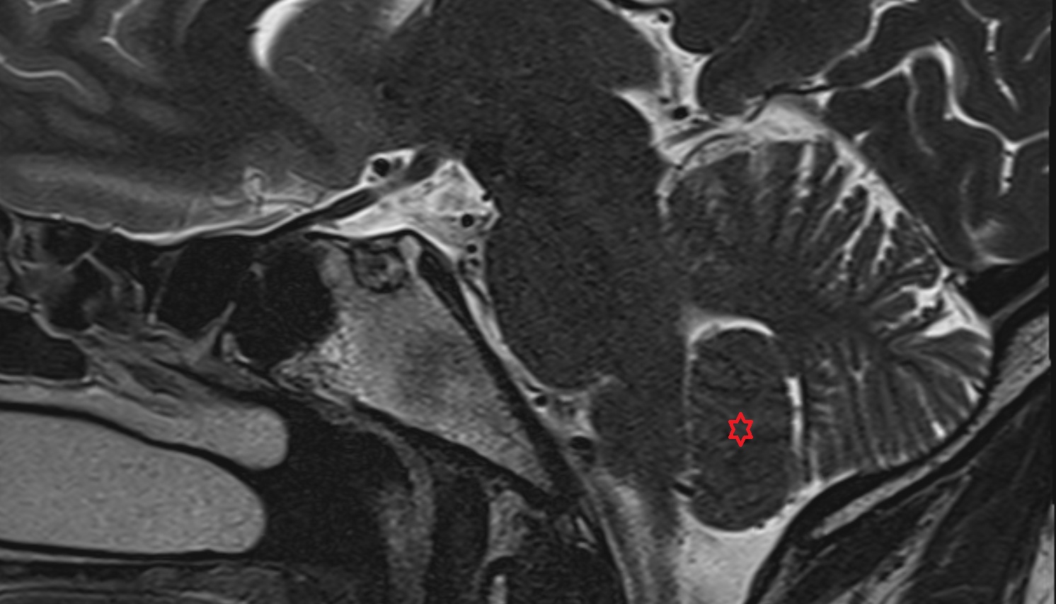 Cerebellar tonsil (H IX)  of Cerebellum mri sag  image -img-00000-00000
