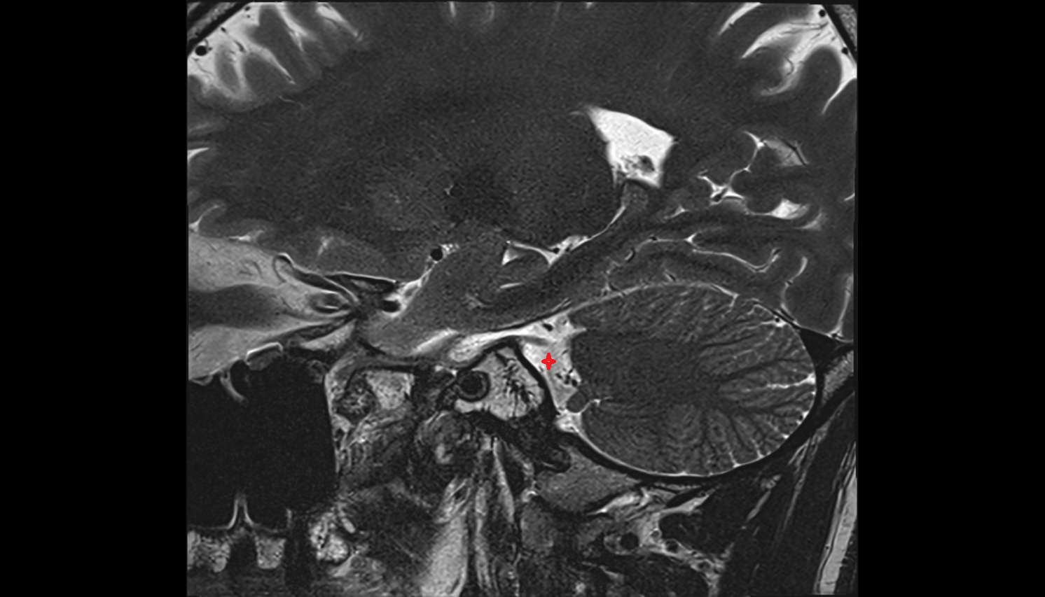 Cerebellopontine cistern mri axial  image -img-00000-00000