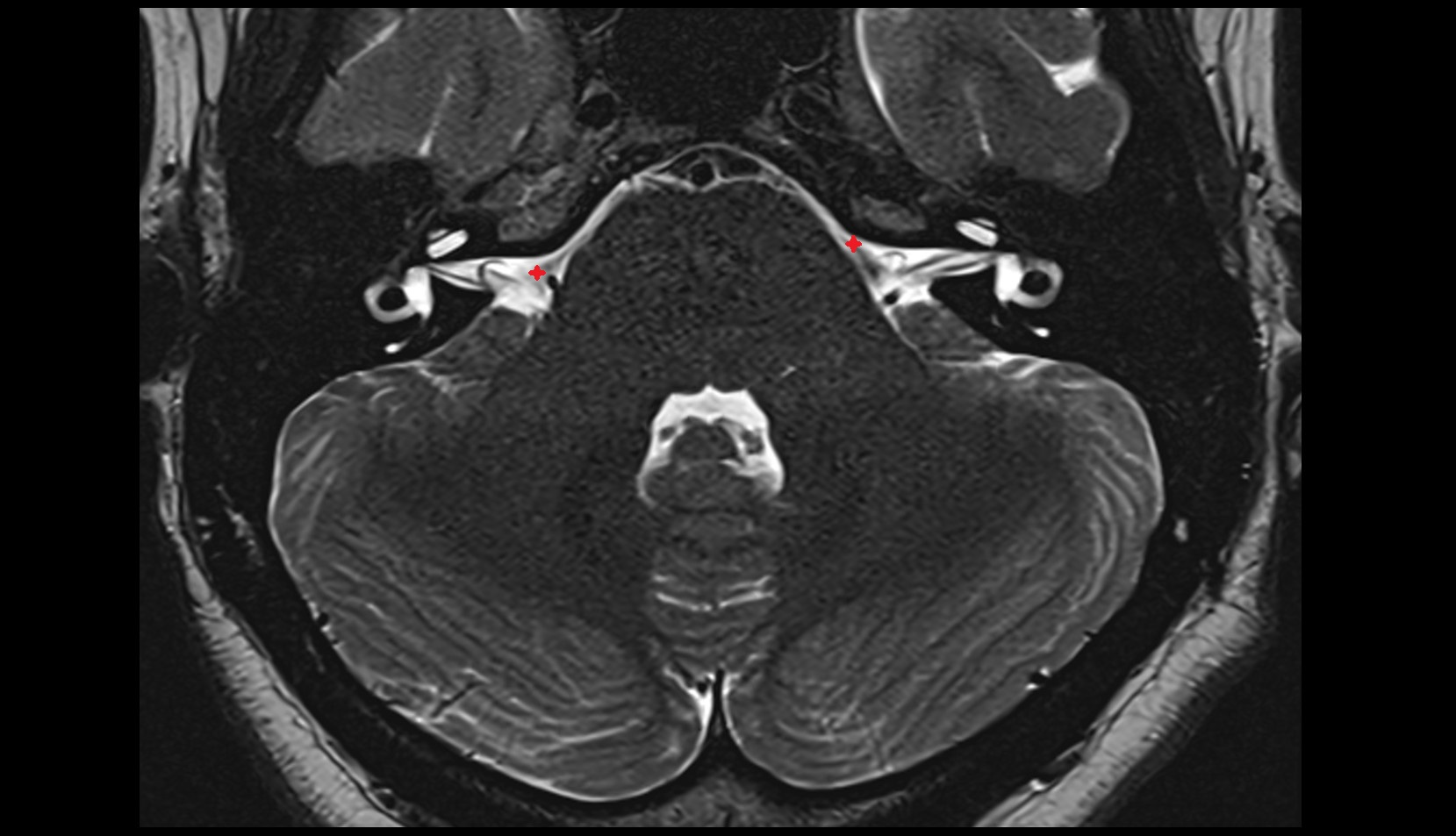Cerebellopontine cistern mri axial image