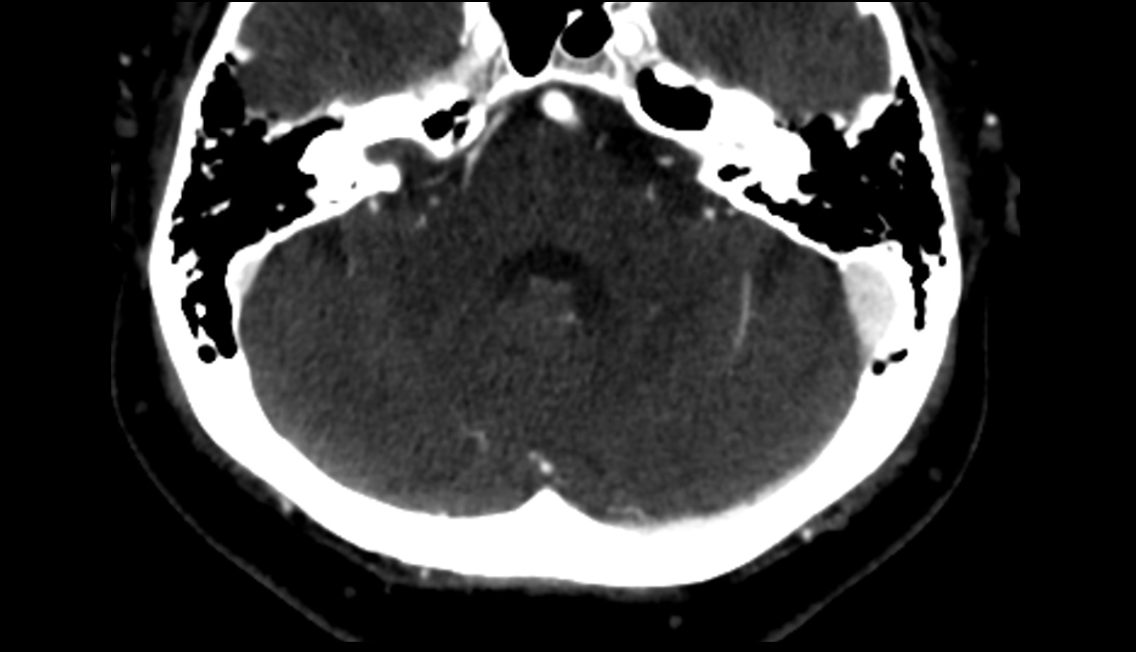 Cerebellum CT  image