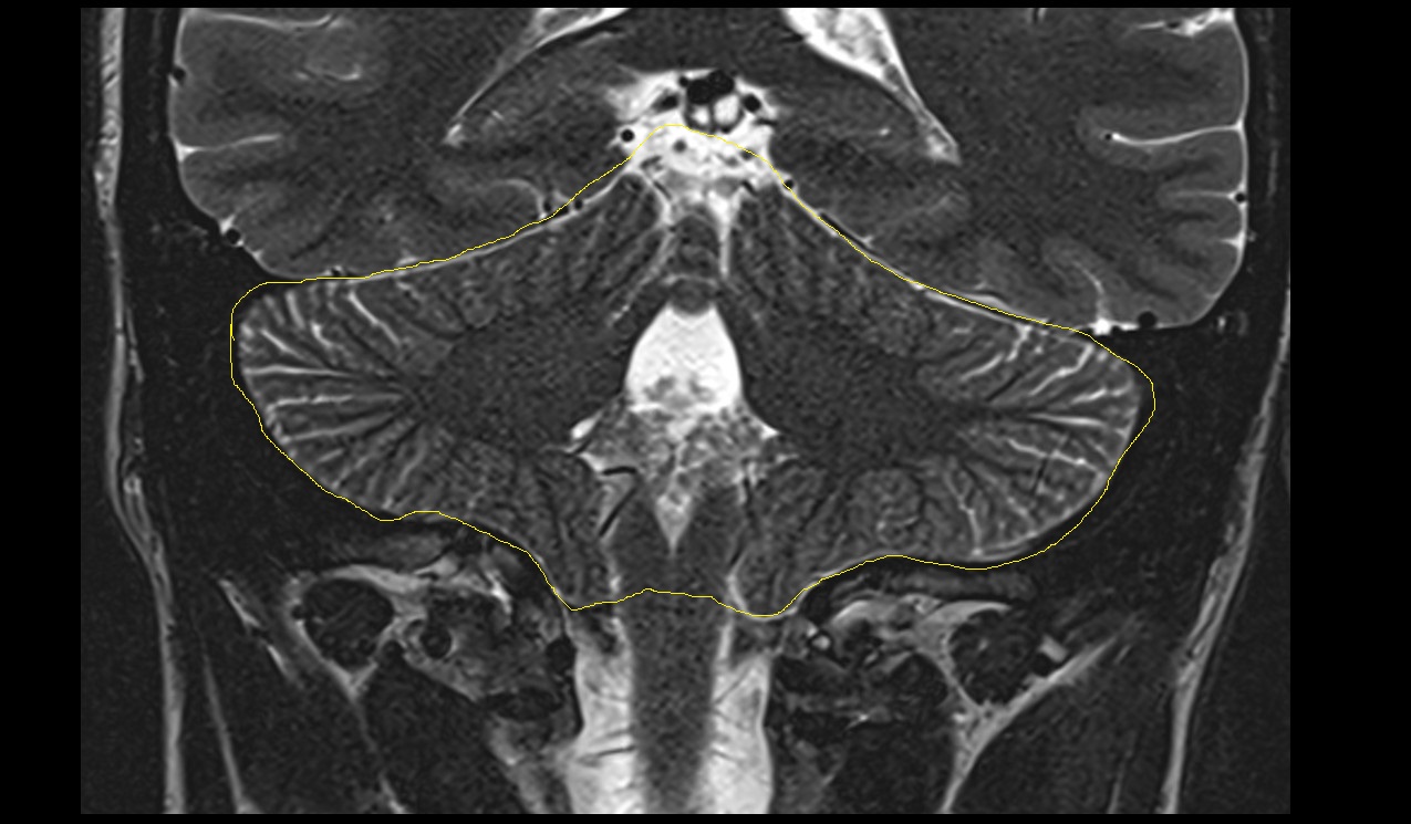 Cerebellum MRI 3T coronal image